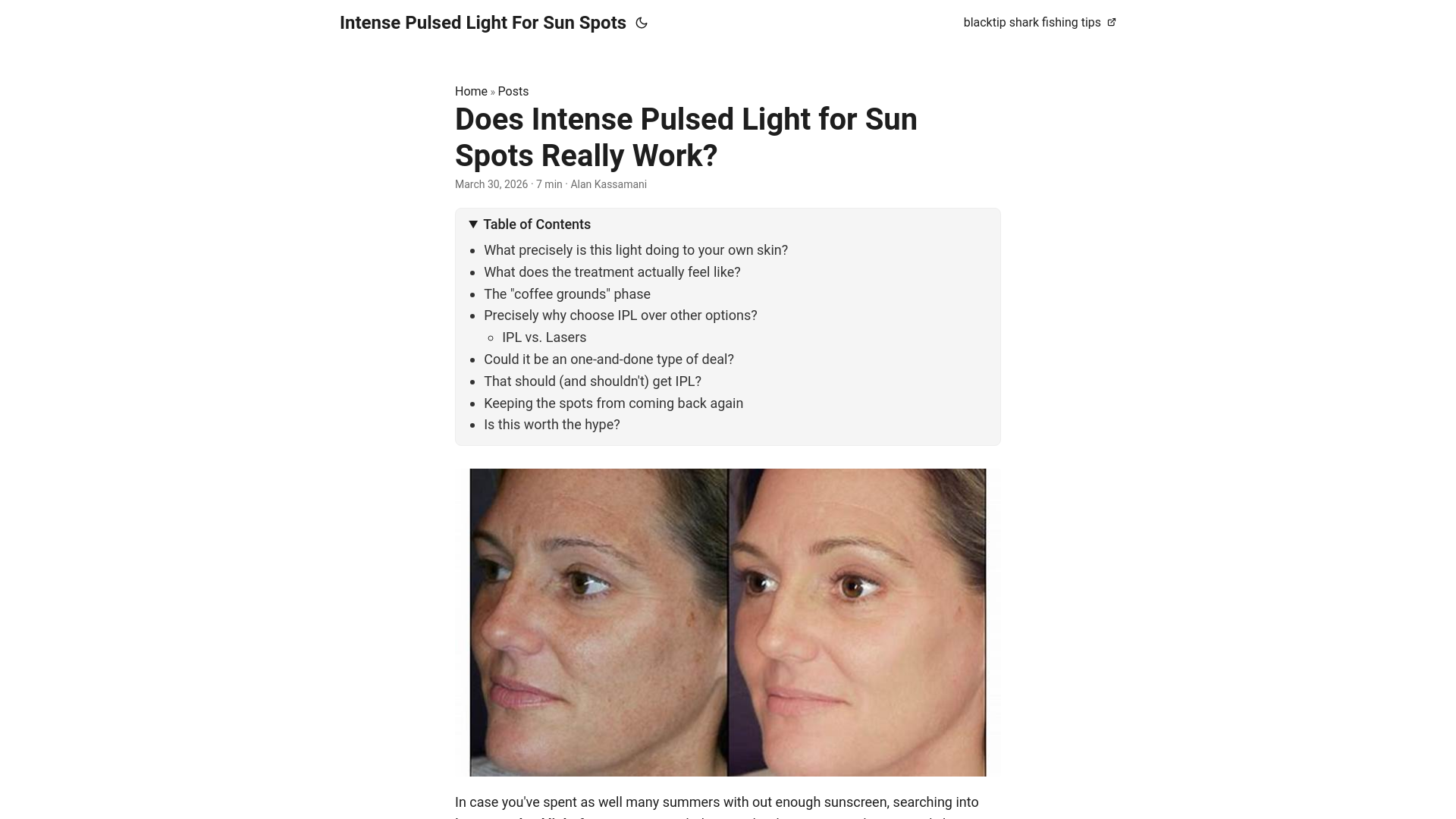 website screenshot of https://intense-pulsed-light-for-sun-spots.pages.dev/