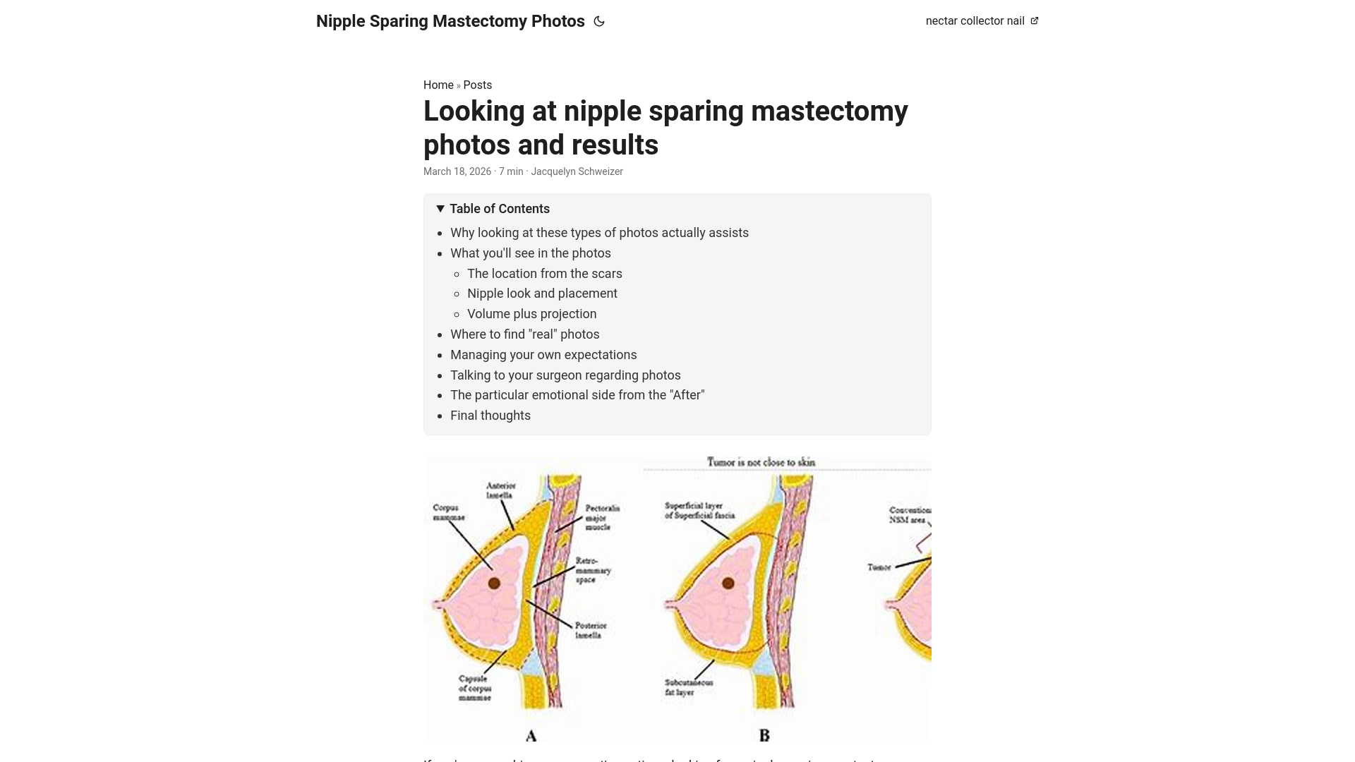 website screenshot of https://nipple-sparing-mastectomy-photos.pages.dev/
